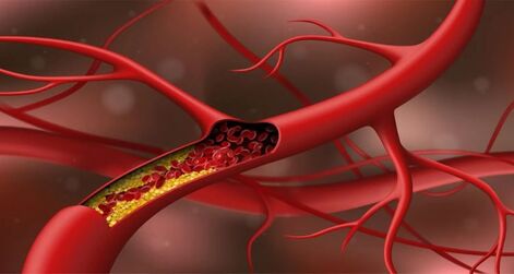 Artritis reumatoidea, colesterol y ateroesclerosis