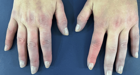 Síndrome de Raynaud: Causas, Síntomas, Tipos, Tratamiento y Prevención